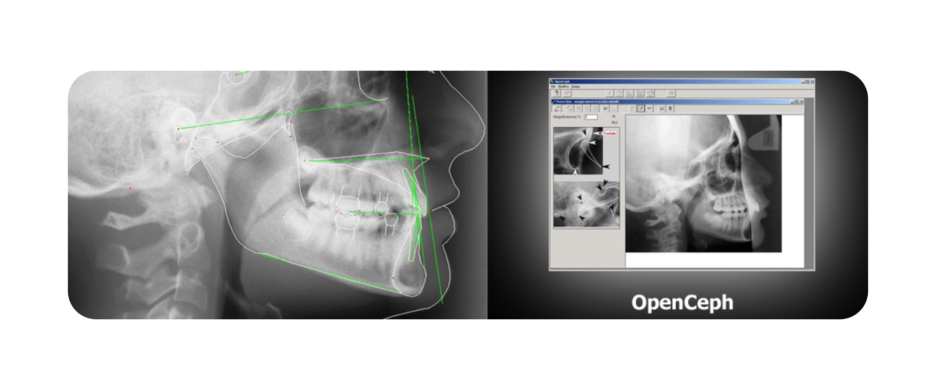 Quaderno Elettronico Addon Programma di Cefalometria Openceph